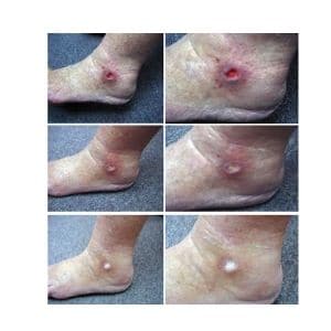 wound healing with grounding